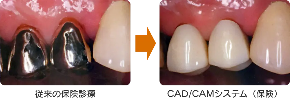 歯科用CAD/CAMシステムによる保険で白い自然な歯を提供